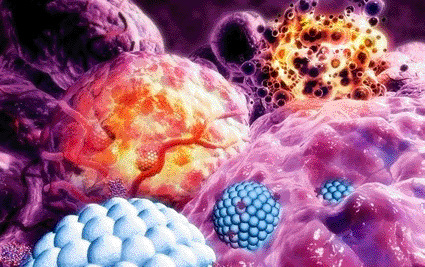 Image: Nanoparticles destroying tumor. Artwork showing nanoparticles (blue) containing cytotoxic drugs, targeting tumor cells (purple), leading to their destruction (orange cells at upper left and upper right) (Photo courtesy of Medi-Mation).
